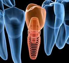 Tratamiento implantes dentales